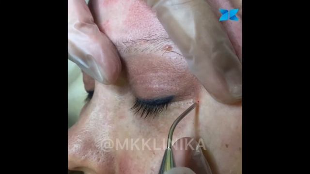 Лазерная блефаропластика. ППИЭ смотреть онлайн