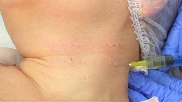 Мезотерапия шейной области (Палатай М.А.) смотреть онлайн