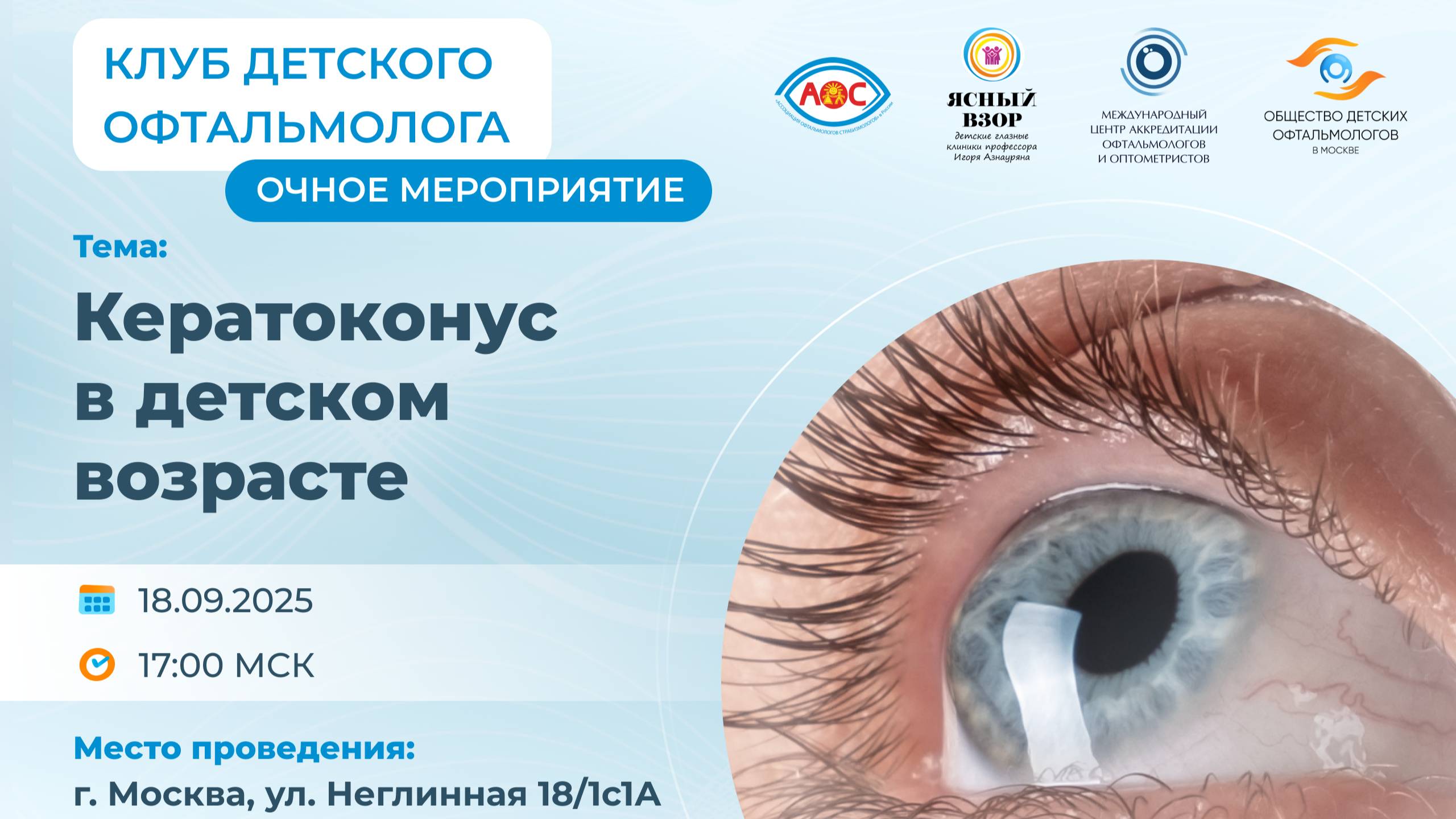 Кератоконус