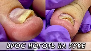 Ноготь не прирастает, скручивается и врастает в конце результат спустя три недели 👍🏼