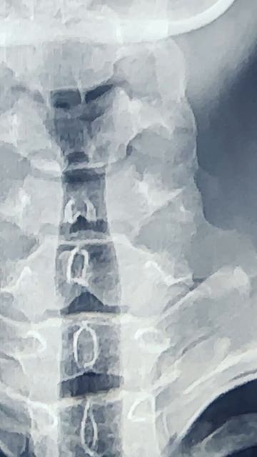 Подвывих шейного позвонка и сколиоз у ребенка смотреть онлайн