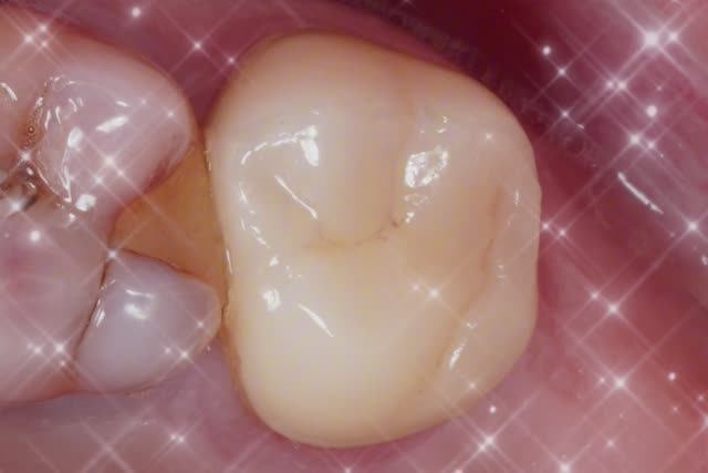 Моляр Фрактура Перелечка