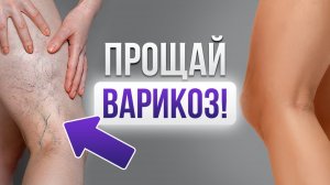 Варикоз на ногах и сосудистые звездочки. Секрет, о котором молчат все флебологи.