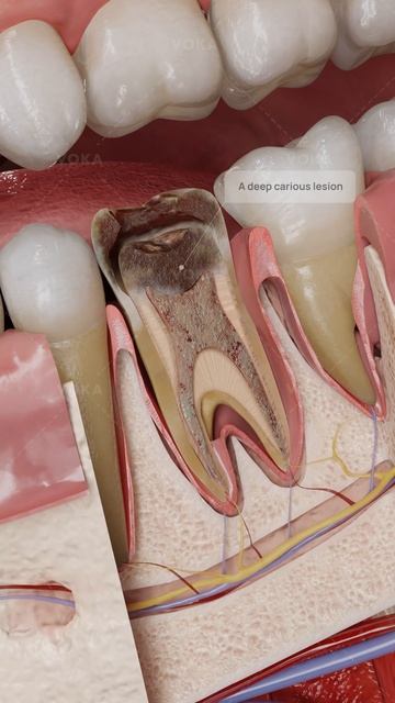 Что такое обратимый пульпит и как его лечить? В 3D