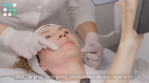 Монополярный RF лифтинг Volnewmer - процедура подтяжки лица без операций | клиника GEN87