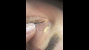 Удаление ксантелазмы