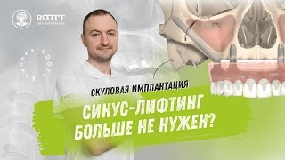 Скуловая имплантация без синус-лифтинга. смотреть онлайн