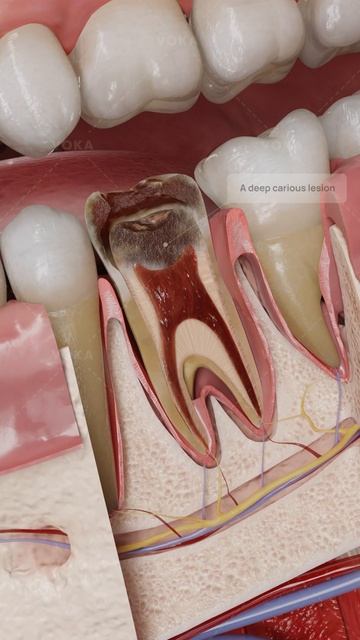 Что такое необратимый пульпит? Стоматология в 3D