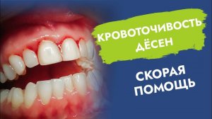 Кровоточат десны. Как быстро устранить?