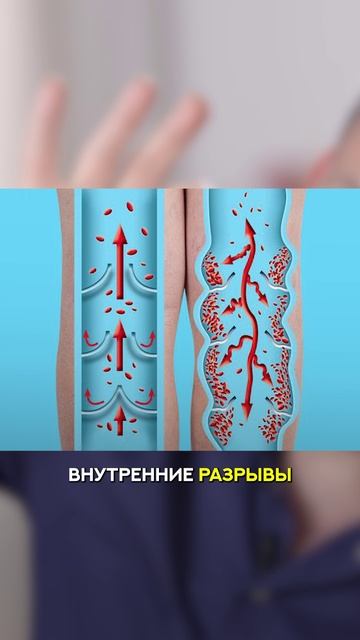 Варикоз — проблема современности смотреть онлайн