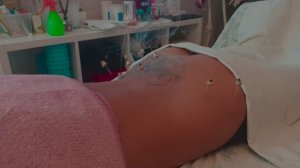 Чтобы убрать спазмы, ставим акупунктурные иглы с прогреванием моксами. Ваш терапевт Олег-Олаф Гудвин