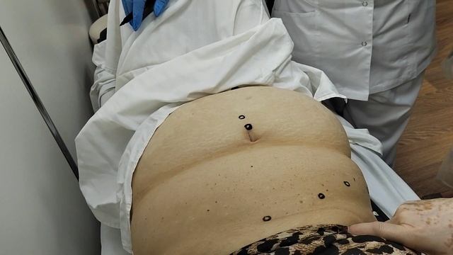 Пример лечения пациента с геморроем. Постприставочная реакция