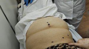 Пример лечения пациента с геморроем. Постприставочная реакция