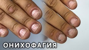 Грызет и ковыряет ногти. Онихофагиярезультат через 3 маникюра в конце видео ❤️
