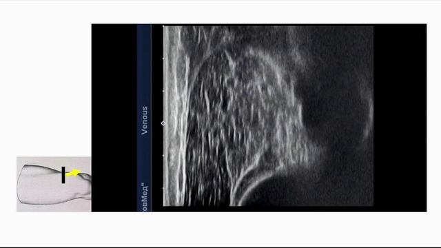 Ультразвуковая анатомия магистральных вен бедра