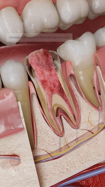 Гиперплазия пульпы: 3D-визуализация необратимого пульпита