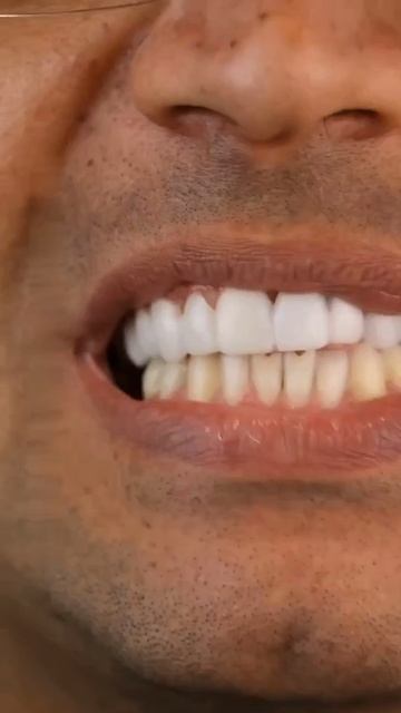 Индивидуальные Съёмные Виниры смотреть короткие видео Shorts от смотреть онлайн