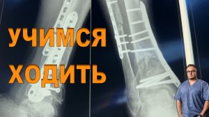 УЧИМСЯ ХОДИТЬ ЧЕРЕЗ 3 МЕСЯЦА ПОСЛЕ ОПЕРАЦИИ | Перелом Голени