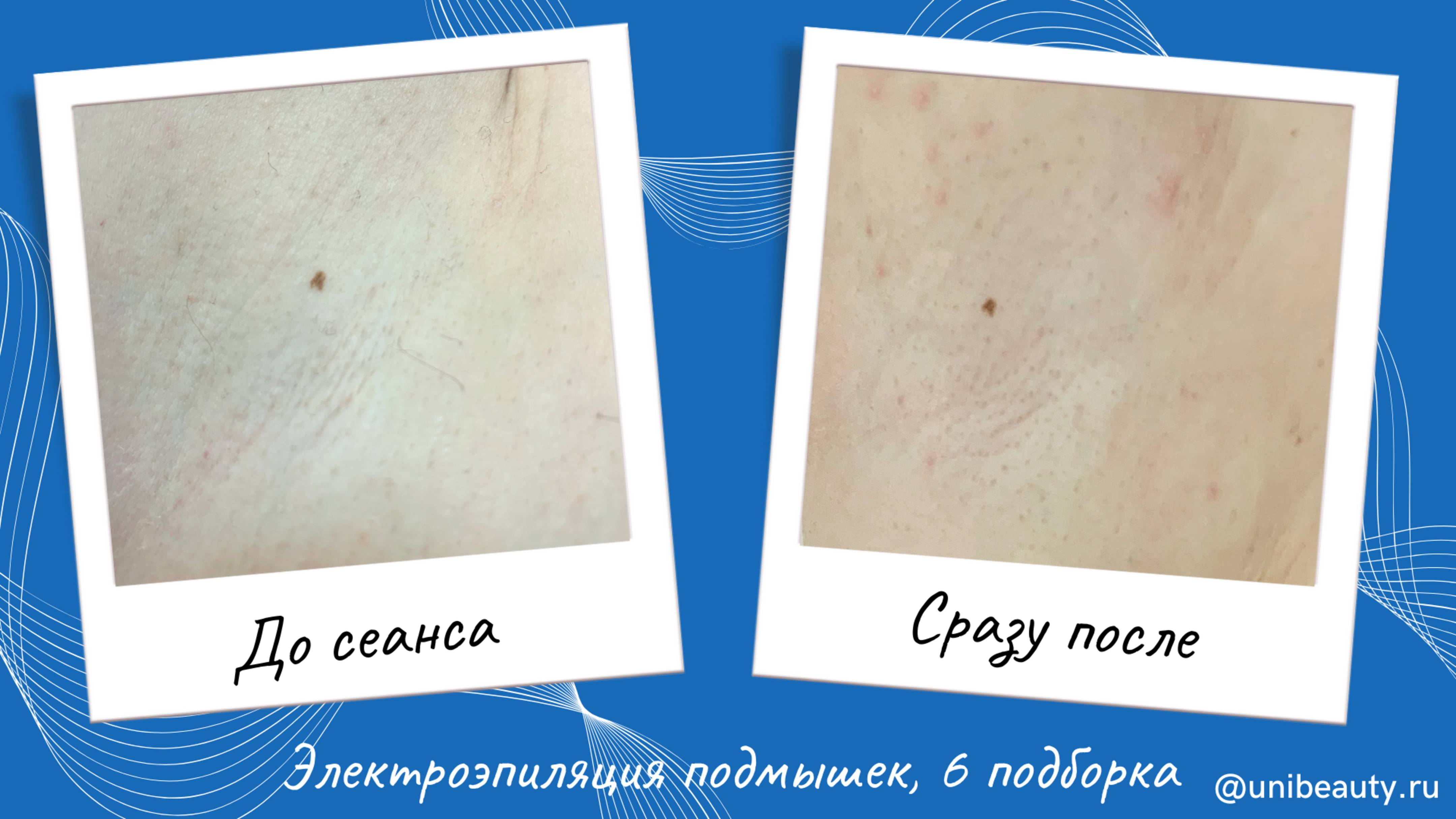 Электроэпиляция подмышек, 6 подборка