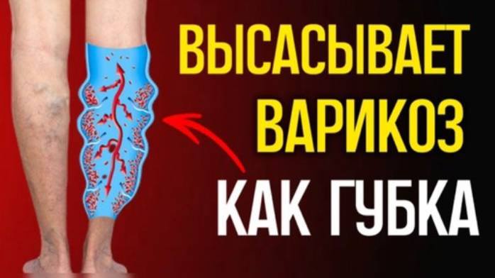 Оказывается, варикоз реально лечится! Простые средства есть у каждого дома смотреть онлайн