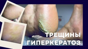 Мини-урок по работе с трещинами | подологический педикюр ROSILAK ☺️