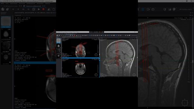 Обучение МРТ гипофиза