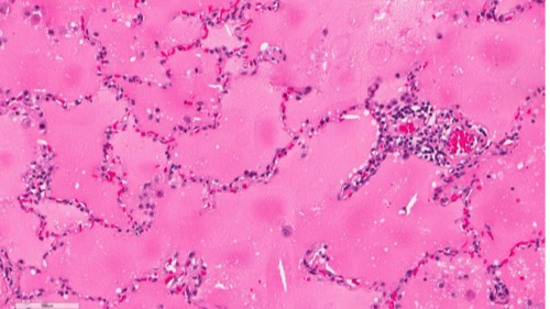 Сложные нарушения кровообращения (НК II) смотреть онлайн