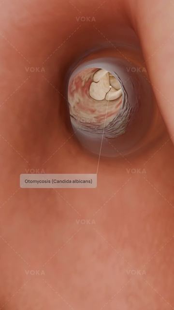 Candida Albicans в оториноларингологии. Объяснение в 3D