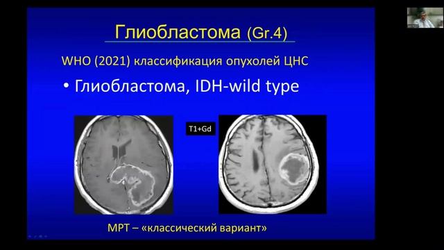 6.1 Опухоли ГМ смотреть онлайн