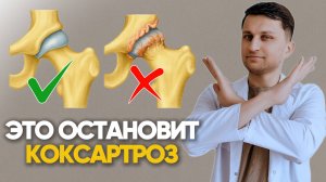 Безопасные упражнения для тазобедренных суставов. Гимнастика для профилактики коксартроза