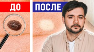 Вы Не ПОВЕРИТЕ Своим Глазам! Как Избавиться от Папиллом и Бородавок за ОДНУ ночь?