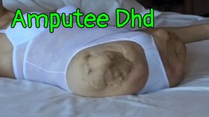 Amputee Dhd