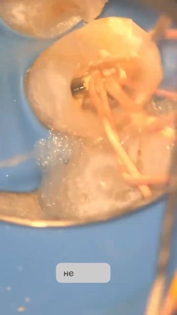 Почему корневые каналы лучше лечить под микроскопом?