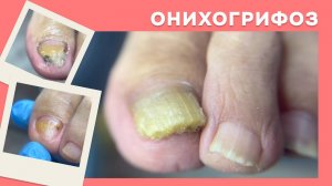 Как быстро убрать толщину ногтя при грифозе? \\ педикюр, подология с ROSILAK