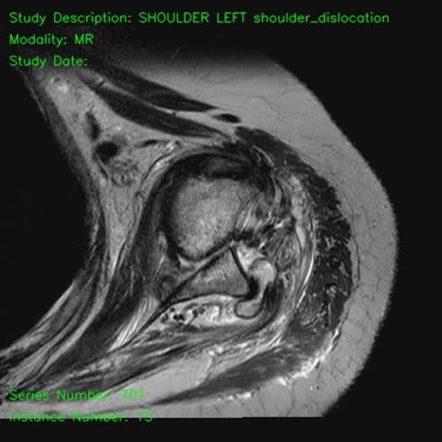 Sarah Connor -- вывих_плеча SHOULDER LEFT shoulder_dislocation смотреть онлайн