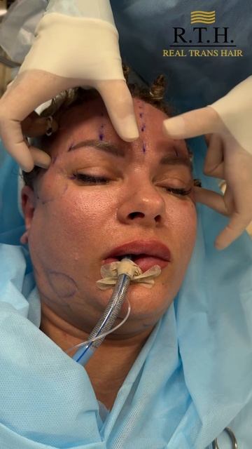 Пластика лица. Комплексное омоложение. смотреть онлайн