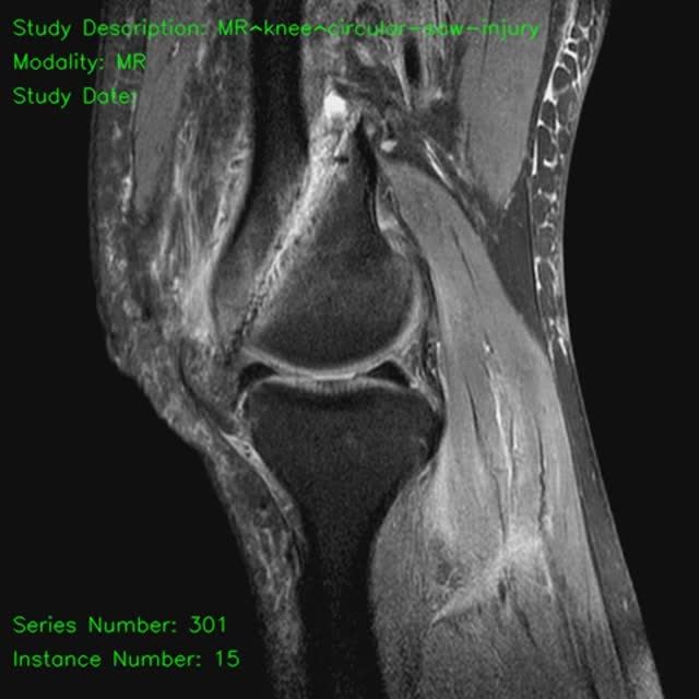 Viridomarus--MR^knee^circular-saw-injury