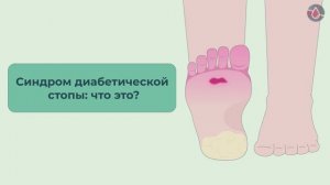 Синдром диабетической стопы: что это?