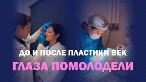 Круговая блефаропластика у Сунгатуллина: до и после