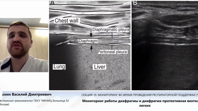 Работа диафрагмы и диафрагм-протективная ИВЛ Конаныхин В.Д.