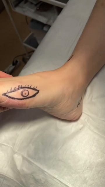 Удаление шишки на ноге Уфа. Вальгусная деформация первого пальца. Hallux Valgus Ufa