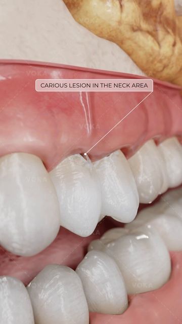 Что такое КАРИЕС V КЛАССА и почему он требует внимания? Изучайте стоматологию в 3D с VOKA!