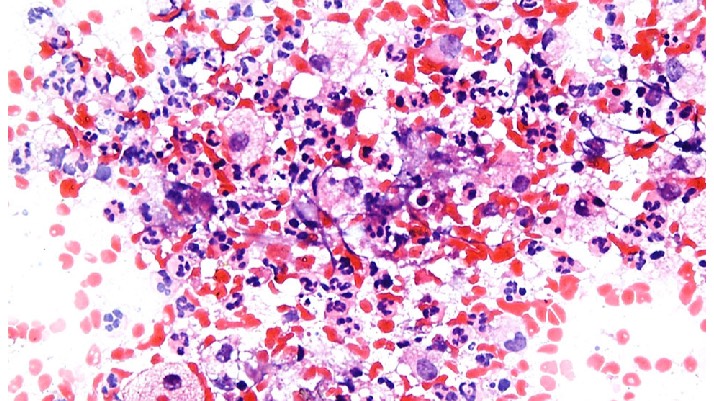 Острое воспаление смотреть онлайн