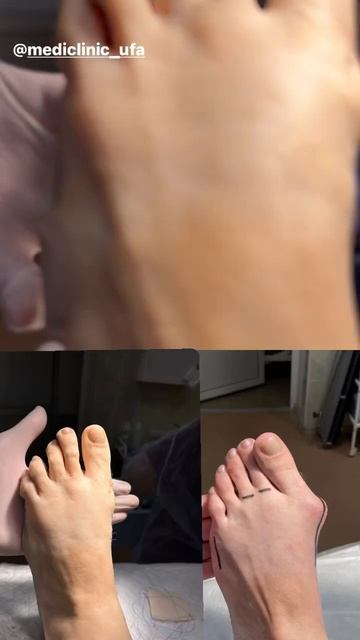 Hallux Valgus Ufa. Реконструкция переднего отдела стопы в Уфе