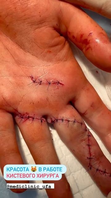 Повреждение сухожилий. Порез. Рана пальца