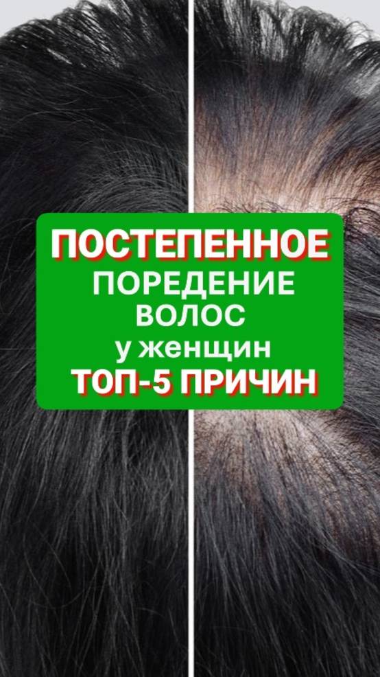 ТОП-5 причин ПОСТЕПЕННОГО поредения волос годами | alopecia.hair #поредениеволос #выпадаютволосы