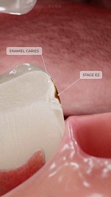 Что такое кариес и как он развивается? Исследуйте стоматологию в 3D