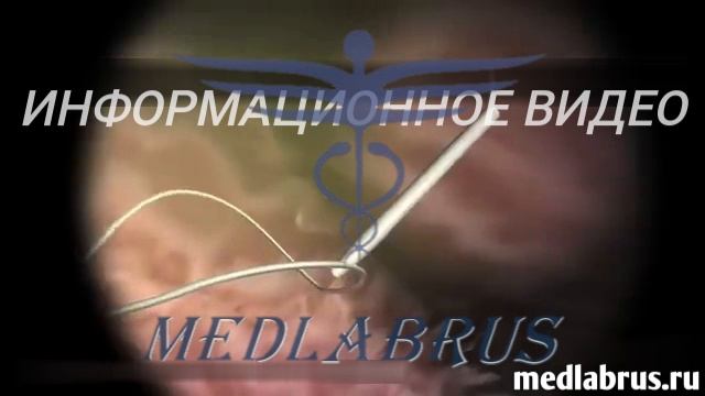 Процедура установки ЧЭГ: чрескожная эндоскопическая гастростомия