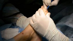 Удаление косточек на ногах