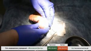 Перевязка после удаления вросшего ногтя